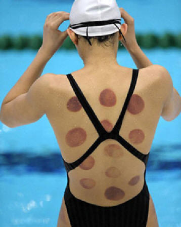 Cupping Marks